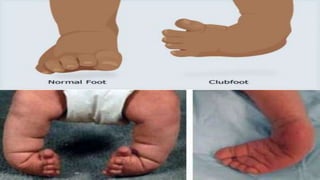 CONGENITAL TALIPES EQUINO VARUS (CTEV) | PPTX