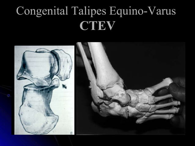 Congenital telipus equino varus, ctev , orthopaedic | PPT