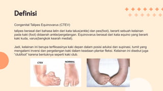 CTEV.pdf congenital tallipes equinovarus | PDF