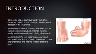 CONGENITAL TALIPES EQUINOVARUS (CTEV) Pptx | PPTX