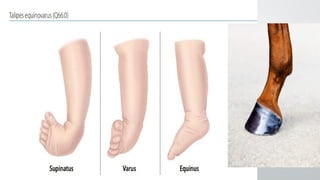 ctev ppt (congenitall talipes equino varus) | PPTX