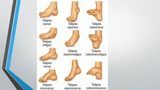 ctev ppt (congenitall talipes equino varus) | PPTX