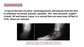 Comprehensive Overview and Management of Congenital Talipes Equino ...