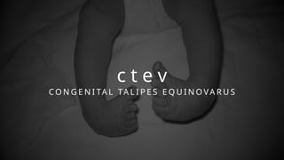 calipes talus equinus varus ppt (1).pptx
