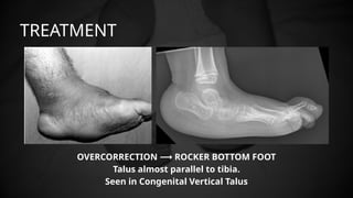 calipes talus equinus varus ppt (1).pptx