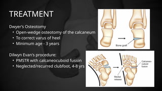 calipes talus equinus varus ppt (1).pptx