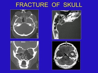 FRACTURE OF SKULL
 