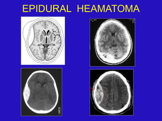 EPIDURAL HEAMATOMA
 