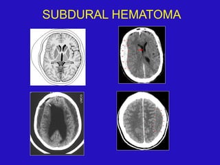 SUBDURAL HEMATOMA
 