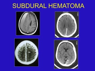 SUBDURAL HEMATOMA
 