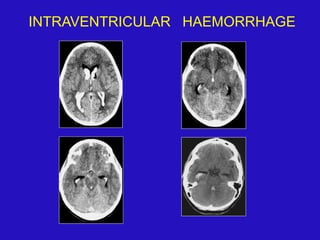 INTRAVENTRICULAR HAEMORRHAGE
 