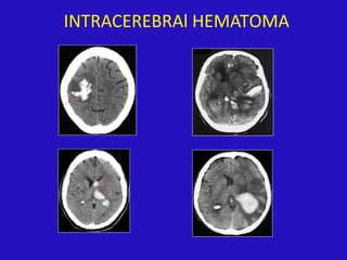 INTRACEREBRAl HEMATOMA
 