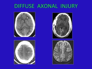 DIFFUSE AXONAL INJURY
 