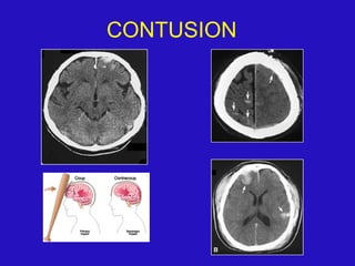 CONTUSION
 