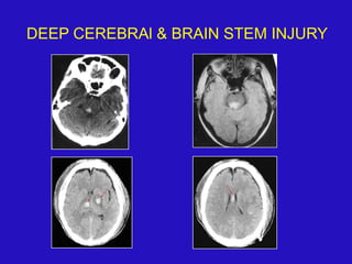 DEEP CEREBRAl & BRAIN STEM INJURY
 