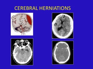CEREBRAL HERNIATIONS
 