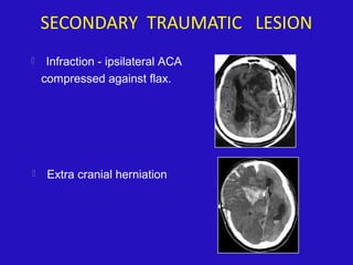 SECONDARY TRAUMATIC LESION
 Infraction - ipsilateral ACA
compressed against flax.
 Extra cranial herniation
 