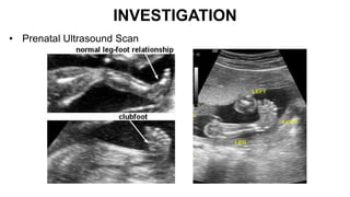 INVESTIGATION
• Prenatal Ultrasound Scan
 