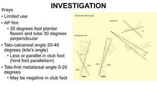 INVESTIGATION
Xrays
• Limited use
• AP film
• 30 degrees foot plantar
flexion and tube 30 degrees
perpendicular
• Talo-calcaneal angle 20-40
degrees (kite’s angle)
• Less or parallel in club foot
(hind foot parallelism)
• Talo-first metatarsal angle 0-20
degrees
• May be negative in club foot
 