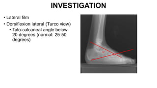 INVESTIGATION
• Lateral film
• Dorsiflexion lateral (Turco view)
• Talo-calcaneal angle below
20 degrees (normal: 25-50
degrees)
 