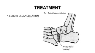 TREATMENT
• CUBOID DECANCELLATION
 