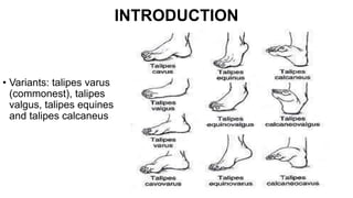 INTRODUCTION
• Variants: talipes varus
(commonest), talipes
valgus, talipes equines
and talipes calcaneus
 