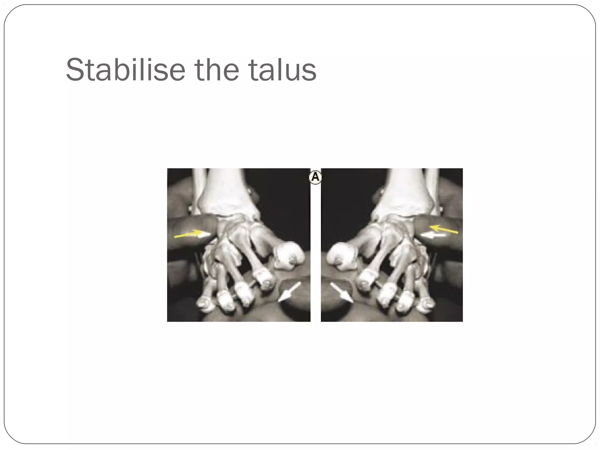 CONGENITAL TALIPES EQUINOVARUS