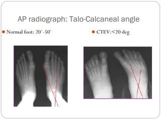 CONGENITAL TALIPES EQUINOVARUS | PPT