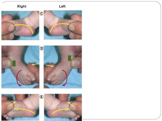 CONGENITAL TALIPES EQUINOVARUS | PPT