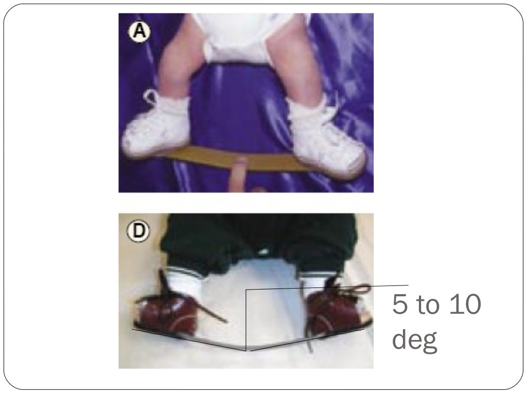 CONGENITAL TALIPES EQUINOVARUS