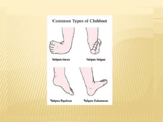 Ctev Types Congenital Talipes Equino Varus (CTEV). Pediatric Physiotherapy | PDF