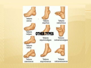 Congenital Talipes Equino Varus (CTEV). Pediatric Physiotherapy | PDF