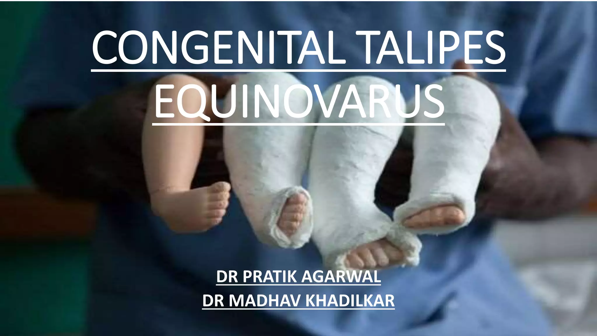 Congenital talipes equinovarus foot/ctev) ppt by Dr Pratik PPT
