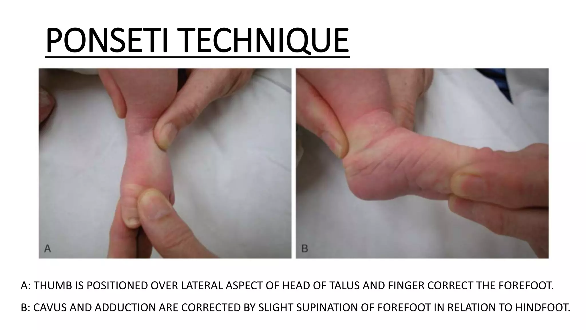 Congenital talipes equinovarus (club foot/ctev) ppt by Dr Pratik | PPTX