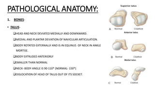 Congenital talipes equinovarus (club foot/ctev) ppt by Dr Pratik | PPTX