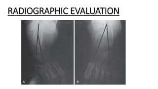 Congenital talipes equinovarus (club foot/ctev) ppt by Dr Pratik | PPTX