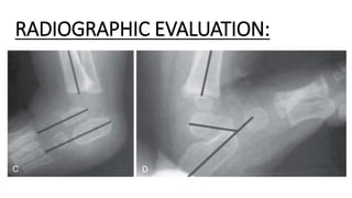 Congenital talipes equinovarus (club foot/ctev) ppt by Dr Pratik | PPTX