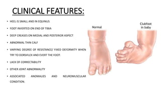 Congenital Talipes Equinovarus Club Foot Ctev Ppt By Dr Pratik Congenital Talipes Equinovarus Club Foot Ctev Ppt By Dr Pratik