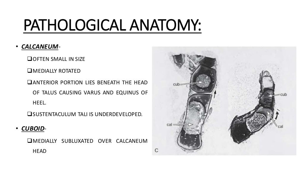 Congenital talipes equinovarus foot/ctev) ppt by Dr Pratik