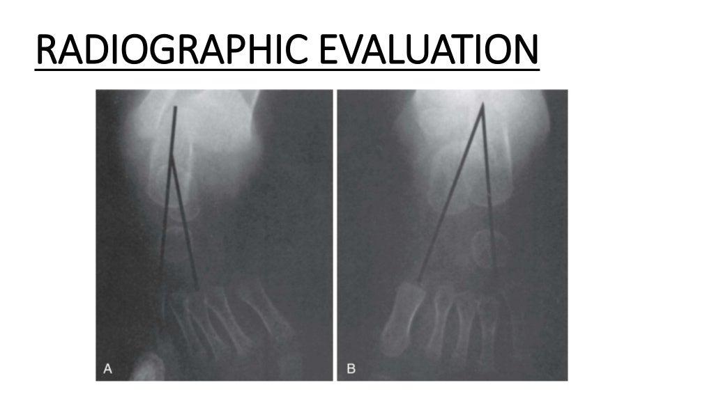 Congenital talipes equinovarus foot/ctev) ppt by Dr Pratik