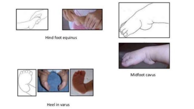 Congenital Talipes Equinovarus Club Foot Ctev Ppt By Dr Pratik Congenital Talipes Equinovarus Club Foot Ctev Ppt By Dr Pratik