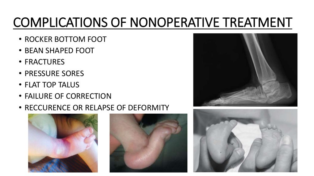 Congenital talipes equinovarus foot/ctev) ppt by Dr Pratik