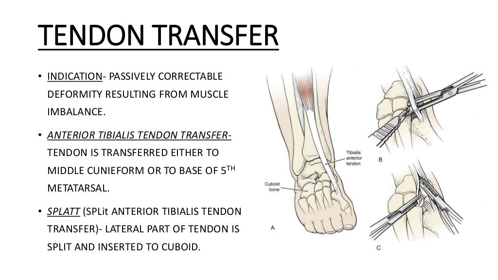 Congenital talipes equinovarus foot/ctev) ppt by Dr Pratik