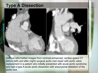 SmokingPatient presents with acute chest pain and history of hypertensionPerform history and physical examination and appropriate cardiac workup, including ECG, laboratory tests, and CXR, to r/o acute coronary syndrome, pulmonary embolism, andother common causes of acute chest painObtain intravenous access (18-gauge catheter in forearm or large-bore central line)Order contrast-enhanced cardiac-gated MDCT of the chest; include abdomen and pelvis if visceral organ or thrombotic symptoms are presentPenetratingatheroscleroticulcerUnstable thoracic aneurysm Type A acute aortic dissection or intramural hematoma Type B acute aortic dissection or intramural hematomaSurgical consultAggressive medicalmanagement**Surgical consult is recommended if imaging features of visceral vessel ischemia,   acute vessel thrombosis, or progression of aneurysmal dilatation are seen or if Marfan syndrome is suspected or known