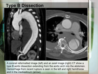 Imaging Studies for Acute Aortic Syndrome