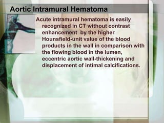 Left, contrast-enhanced, nongatedCT study with 3-mm slices of the aortic root from a patient with acute aortic syndrome demonstrates cardiac motion artifact mimicking an acute aortic dissection (arrows, left panel). Right, contrast-enhanced, cardiacgated CT with 0.75-mm slices of the aortic root reveals no dissection, although the aortic root is dilated.