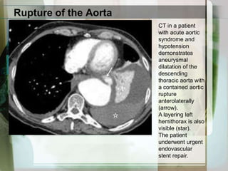 Type A DissectionCoronal reformatted image (left) and oblique reformatted image (right) from contrast-enhanced, cardiac-gated CT in a patient with acute aorticsyndrome show a type A aortic dissection involving the aortic root, extending around the aortic valve, and aneurysmaldilatation of the aortic root.