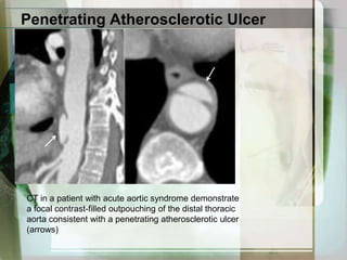 Aortic Intramural HematomaCoronal reformatted image (left) and axial image (middle) CT in a patient with an acute type A intramural hematoma and a penetrating ulcer. Note the eccentric increased attenuation in the lateral aspect of the aortic arch representing the hematoma (arrow, middle panel) and the contrast-filled outpouchinglaterally representing the penetrating ulcer.Follow-up imaging several months later (right) shows that the intramural hematoma resolved although the penetrating ulcer persisted (arrow, right panel).