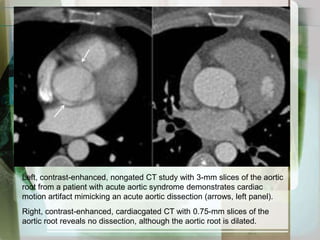 Renal diseaseIatrogenic factorsEndovascular instrument