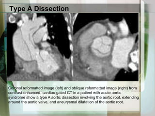 Valvular or aortic surgeryModifiable risk factorsCocaine or other illicit drug use